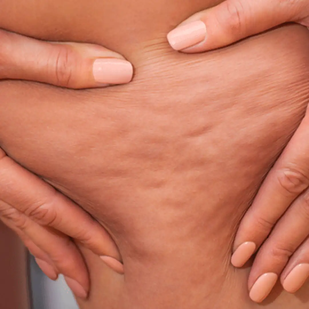 Celulite que não diminui mesmo com exercícios?